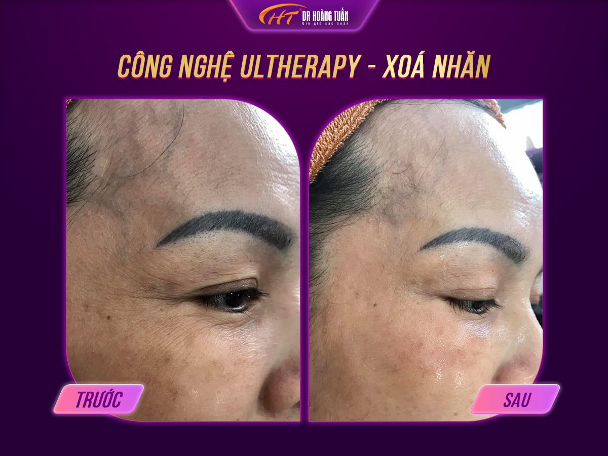Công nghệ trẻ hóa da Ultherapy